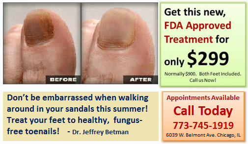 Fungal Toenails Treatment and restoration in the Cook County, IL: Northwest Chicago (Maywood, Elmhurst, Cicero, Oak Park, Rosemont, Evanston, Des Plaines, Glenview, Elk Grove Village, Lombard), Ukrainian Village / Wicker Park (Norridge, Maywood, Melrose Park, Berwyn, Westchester, Lincolnwood, Niles) and Southwest Chicago (Bridgeview, Burbank, Alsip, Orland Park, Lemont, Tinley Park) areas