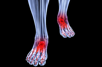 Arthritic foot and ankle care treatment, foot arthritis treatment in the Cook County, IL: Northwest Chicago (Maywood, Elmhurst, Cicero, Oak Park, Rosemont, Evanston, Des Plaines, Glenview, Elk Grove Village, Lombard), Ukrainian Village / Wicker Park (Norridge, Maywood, Melrose Park, Berwyn, Westchester, Lincolnwood, Niles) and Southwest Chicago (Bridgeview, Burbank, Alsip, Orland Park, Lemont, Tinley Park) areas