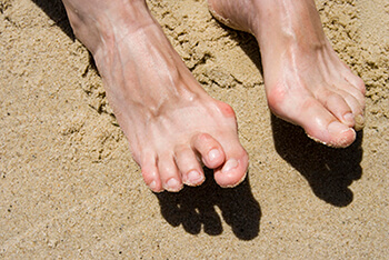 Hammertoes and Mallet Toes treatment in the Cook County, IL: Northwest Chicago (Maywood, Elmhurst, Cicero, Oak Park, Rosemont, Evanston, Des Plaines, Glenview, Elk Grove Village, Lombard), Ukrainian Village / Wicker Park (Norridge, Maywood, Melrose Park, Berwyn, Westchester, Lincolnwood, Niles) and Southwest Chicago (Bridgeview, Burbank, Alsip, Orland Park, Lemont, Tinley Park) areas