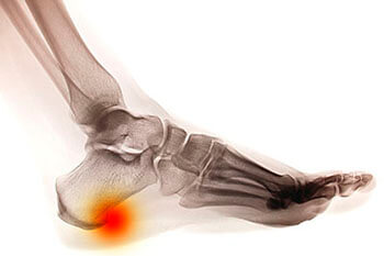 Heel spurs treatment in the Cook County, IL: Northwest Chicago (Maywood, Elmhurst, Cicero, Oak Park, Rosemont, Evanston, Des Plaines, Glenview, Elk Grove Village, Lombard), Ukrainian Village / Wicker Park (Norridge, Maywood, Melrose Park, Berwyn, Westchester, Lincolnwood, Niles) and Southwest Chicago (Bridgeview, Burbank, Alsip, Orland Park, Lemont, Tinley Park) areas