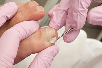 Ingrown toenails treatment in the Cook County, IL: Northwest Chicago (Maywood, Elmhurst, Cicero, Oak Park, Rosemont, Evanston, Des Plaines, Glenview, Elk Grove Village, Lombard), Ukrainian Village / Wicker Park (Norridge, Maywood, Melrose Park, Berwyn, Westchester, Lincolnwood, Niles) and Southwest Chicago (Bridgeview, Burbank, Alsip, Orland Park, Lemont, Tinley Park) areas