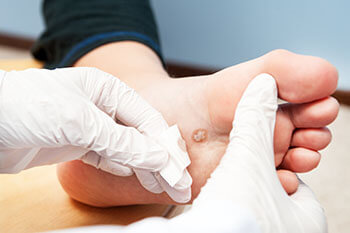 Plantar warts treatment in the Cook County, IL: Northwest Chicago (Maywood, Elmhurst, Cicero, Oak Park, Rosemont, Evanston, Des Plaines, Glenview, Elk Grove Village, Lombard), Ukrainian Village / Wicker Park (Norridge, Maywood, Melrose Park, Berwyn, Westchester, Lincolnwood, Niles) and Southwest Chicago (Bridgeview, Burbank, Alsip, Orland Park, Lemont, Tinley Park) areas