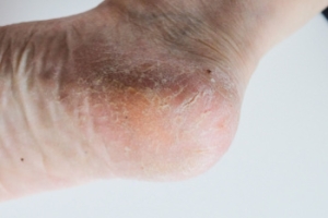 Causes and Podiatric Solutions for Cracked Heels