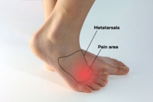 Symptoms and Risk Factors of Morton’s Neuroma
