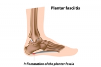 How Is Plantar Fasciitis Treated?