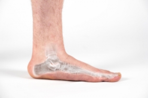 Exercises Aimed at Flat Feet