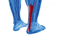 Dealing With Achilles Tendonitis